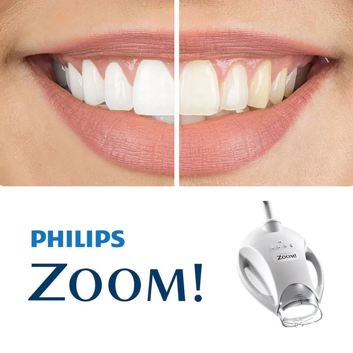 Albire Dentară Profesională Albire Dentară Profesională cu Philips Zoom la Dental CATTED