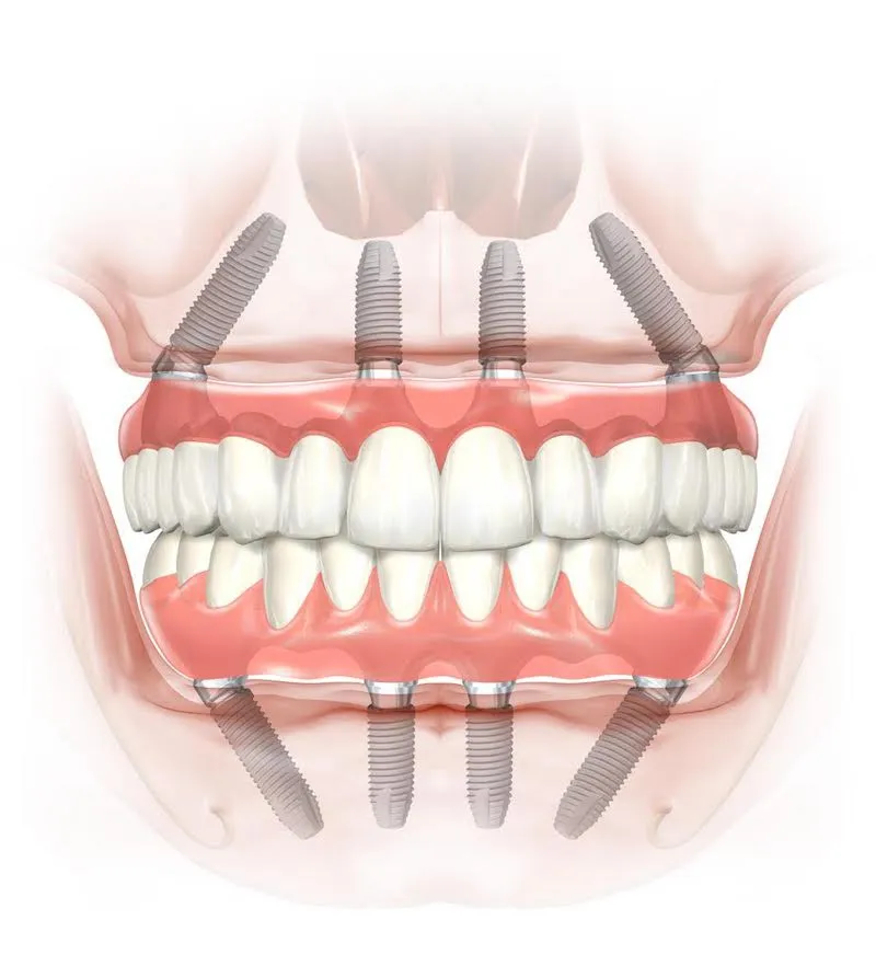 Implanturi All-on-4 la Dental CATTED in Pipera