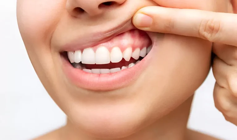 Gingivita Vs. Parodontoza: Cum Să Recunoști Și Să Previi Boala Parodontală? Gingivita versus Parodontoza - Cum Sa Recunosti Parodontita - clinica stomatologica Dental CATTED.