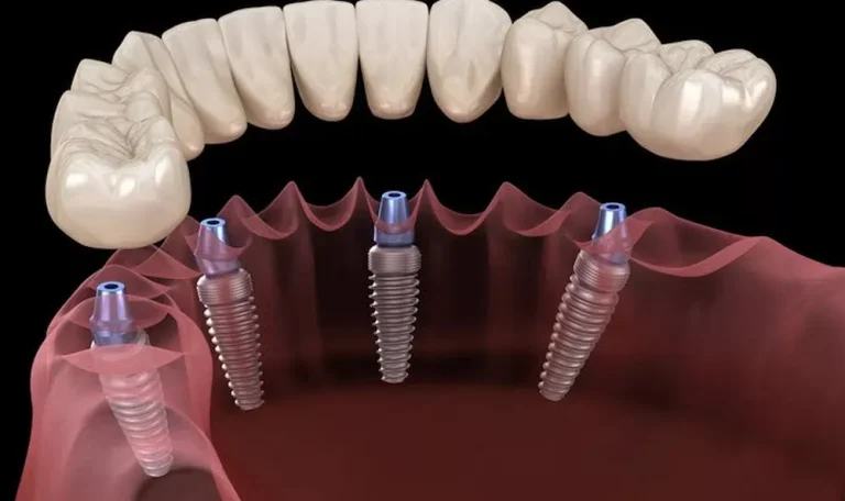 Implanturi All-On-4 la Dental CATTED