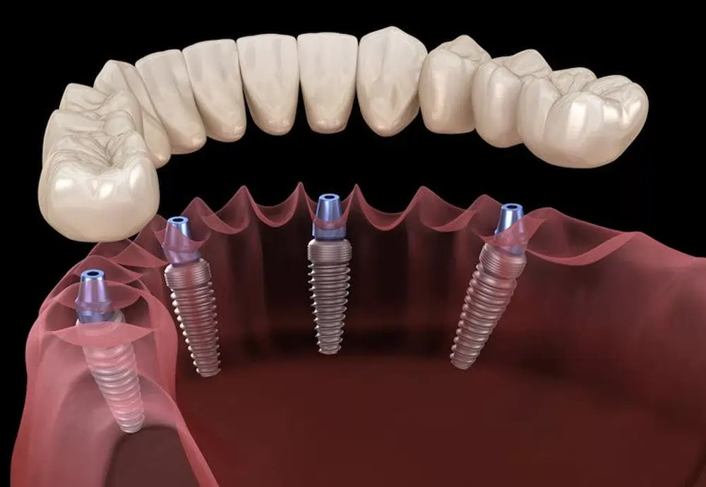 Implanturi All-On-4 la Dental CATTED
