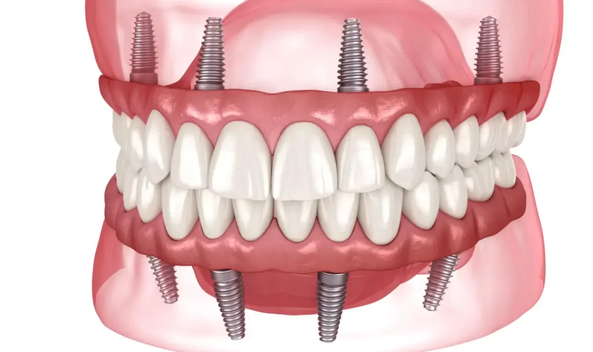 Diagrama cu implanturi All-on-4 in maxilar si mandibula si proteza dentara atasata.