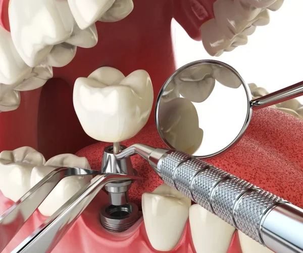 Implant Dentar în Pipera la Clinica Stomatologică Dental CATTED