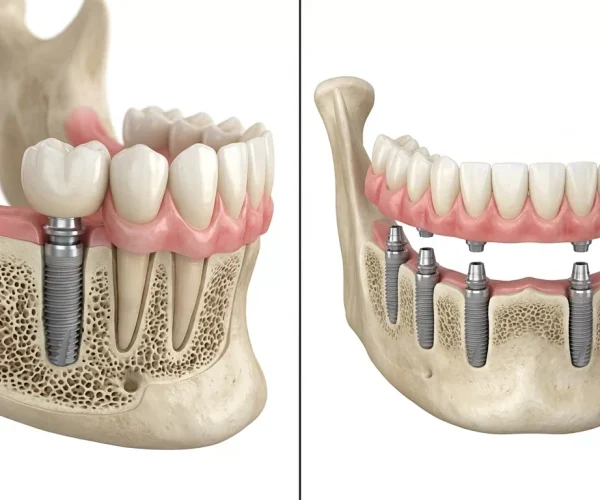 Comparație vizuală între un implant dentar singular și o lucrare protetică pe mai multe implanturi, cu aliniere corectă și distribuție echilibrată a forțelor
